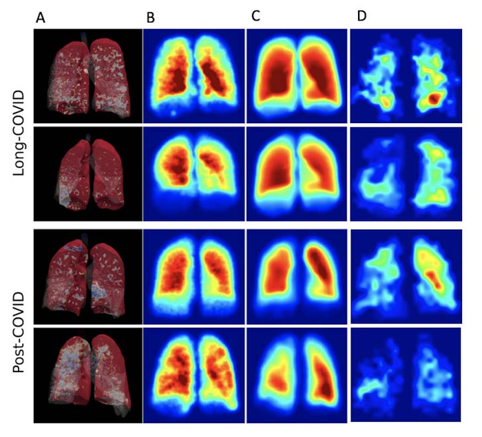 3D render of full-scale airway network modelling analysis (FAN) (A), FAN modelling (B), and hyperpolarized Xenon imaging (C, D) in both non-hospitalized post-Covid-19 condition and post-hospitalized COVID-19 participants.