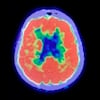 PET SCAN Dementia