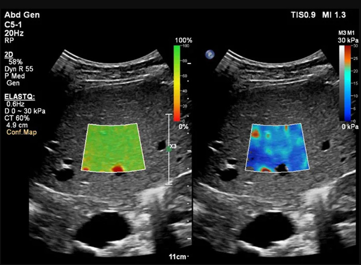 An investment in shear wave elastography is not just in breast health, as it can be utilized in other clinical applications, such as liver disease. Philips’ ElastQ imaging is a real-time, large region of interest (ROI), color-coded quantitative assessment of tissue stiffness. Clinicians can easily assess liver tissue stiffness using real time feedback and make quantitative measurements with multiple sample points. Image courtesy of Philips Healthcare.