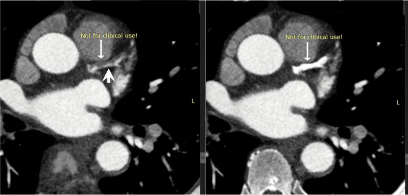 The inherent spectral capabilities of Mayo Clinic's new third-generation photon-counting CT research scanner allows clear visualization of the intact portions of the coronary artery lumen (arrowhead) by reducing the bright signal from the dense coronary calcifications (arrows). Spectral CT is able to bin photos on different energies that can be used to enhance or subtract chemical elements from the images based on their spectral signature, such as calcium shown here, and iodine.