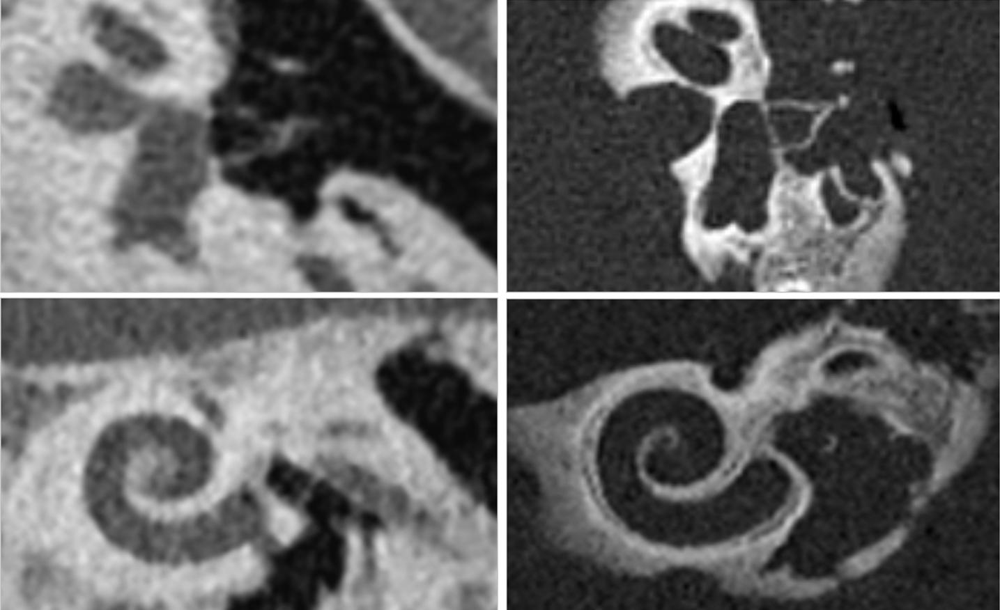 Improved visualization of the middle and inner ear enabled by photon-counting CT. Tiny anatomical structural of the middle and inner ear such as the stapes (upper row), and the cochlea (lower row). The left images were acquired using conventional CT imaging and the images on the right use photo-counting CT. Images courtesy of Dr. A. Persson, Linkoping University, Sweden.