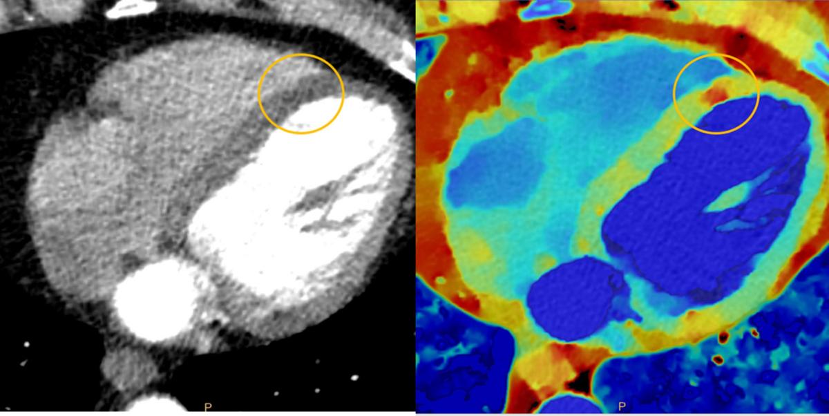 myocardial perfusion