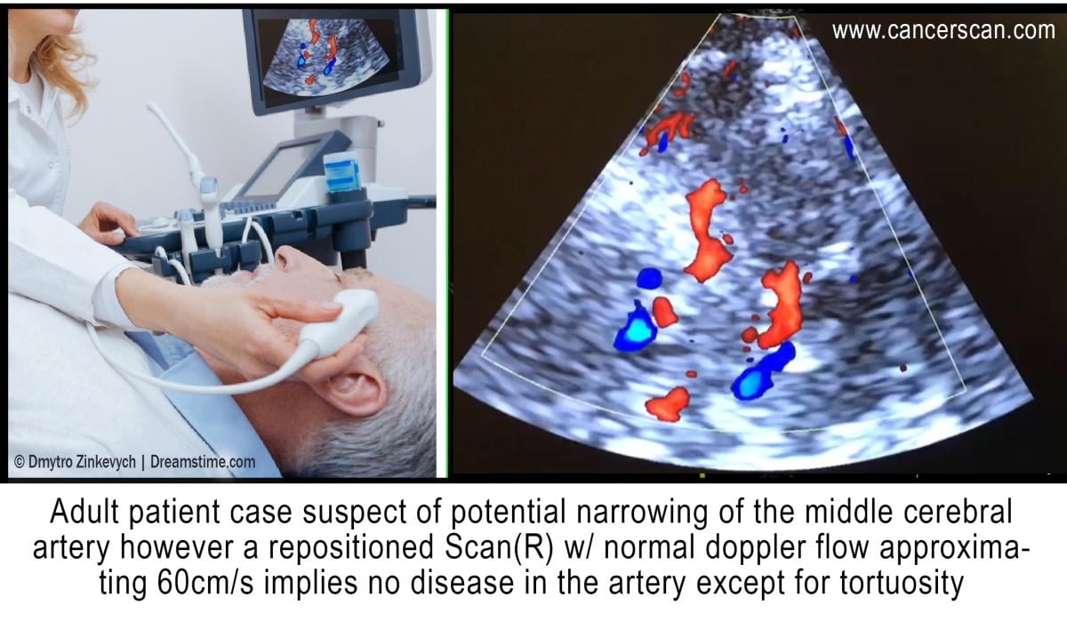 Doppler ultrasound