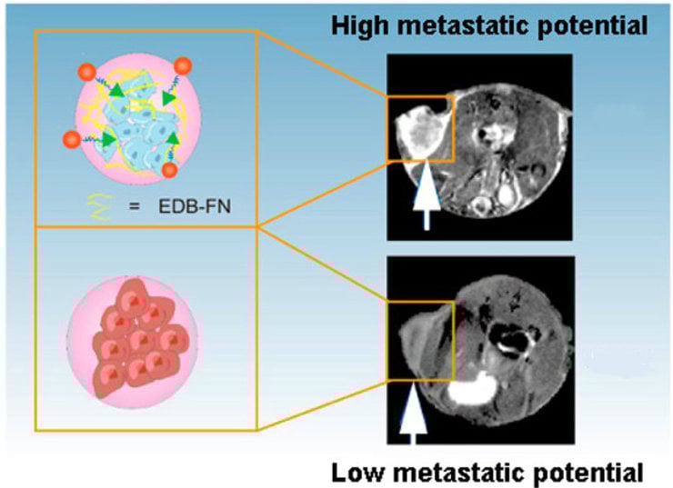 aggressive cancer prostate