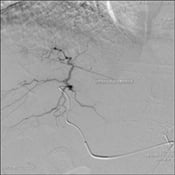 Arteriogram - questionable hypervascular mass