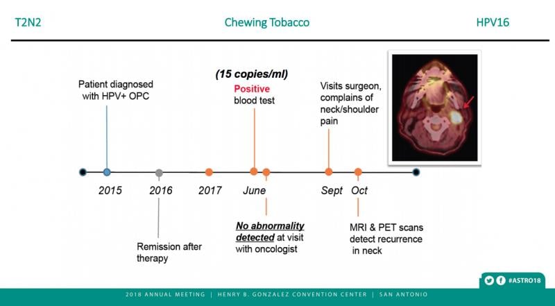 Biomarker blood test accurately confirms remission in a chewing tobacco user with HPV-associated oral cancer. At ASTRO 2018 #ASTRO2018 #ASTRO #ASTRO18