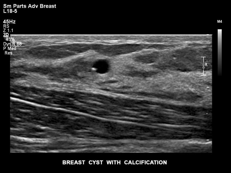 Philips Epiq ultrasound image of a breast cyst and calcifications. Breast ultrasound is often used as an augmentation of mammography in women with dense breast tissue. 