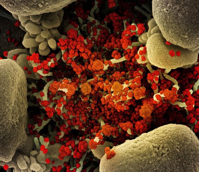 Colorized scanning electron micrograph of an apoptotic cell (tan) heavily infected with SARS-CoV-2 virus particles (orange), isolated from a patient sample. Image captured at the National Institute of Allergy and Infectious Diseases (NIAID) Integrated Research Facility (IRF) in Fort Detrick, Maryland. Photo courtesy of NIAID
