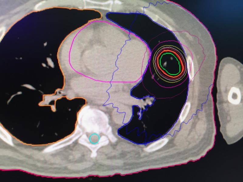 An example of motion tracking for a lung cancer tumor radiotherapy using the new Synchrony for Radixact, motion tracking and correction technology.#ASTRO19 #ASTRO2019 #ASTRO