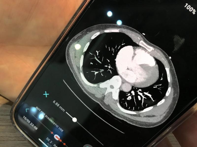 Aidoc's artificial intelligence pulmonary embolism response team (PERT) activation app showing how the CT scan can be viewed on a smartphone. The orange dots at the bottom of the page mark key slices were the AI detected pulmonary emboli.
