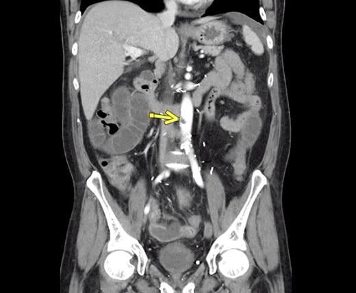 Aortic thrombosis from COVID at the level of the inferior superior mesenteric artery. The patient also had superior mesenteric artery thrombosis complicated by bowel ischemia and perforation in this 54-year-old man who presented to the emergency department with abdominal pain and was diagnosed with COVID-19. 