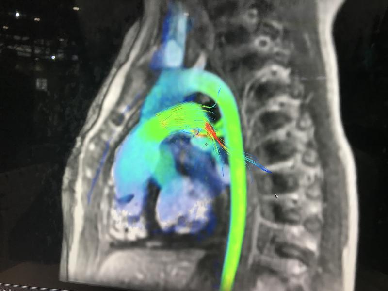 AI-enabled cardiac MRI flow analysis from Arterys. 