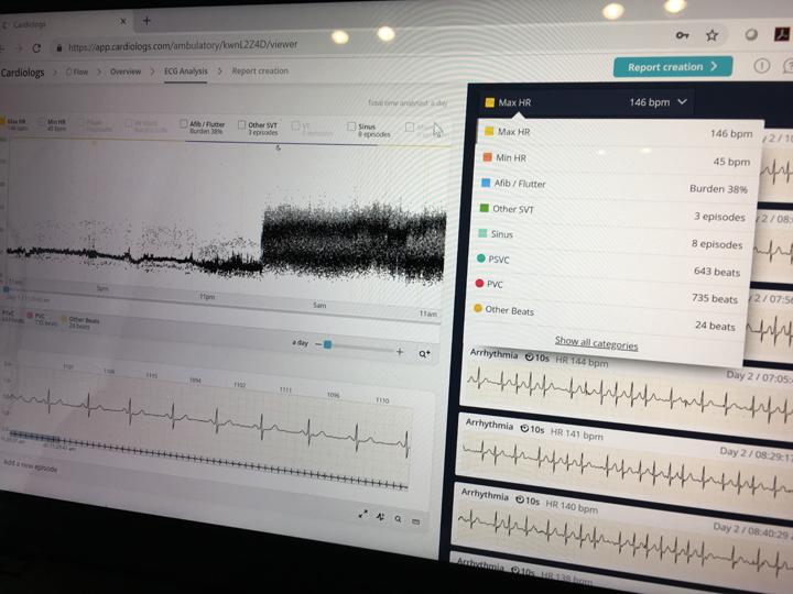The company Cardiologs demonstrated for DAIC today at HIMSS 2019 its artificial intelligence ECG interpretation software. It has European CE mark and FDA clearances to detect a variety of arrhythmias from various ECG sources, from 1 to 12 lead. The AI uses a histogram of the digital data from the ECG (the fuzzy seismic-looking waveform in the photo) and the rhythm strip to interpret the exam. It was trained using pattern recognition with more than 1 million ECGs.