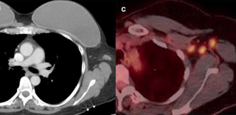 Example of vaccine-caused axillary adenopathy. A 46-year-old female with triple negative left breast cancer, disease free for three years. Left, surveillance contrast enhanced axial chest CT showed new left axillary lymphadenopathy with fat stranding 15 days after the first COVID-19 vaccine. Right, further evaluation with PET/CT six days after the 2nd dose of vaccine, demonstrated multiple enlarged hypermetabolic left axillary lymph nodes. Read more in the original study. Image courtesy of RSNA.