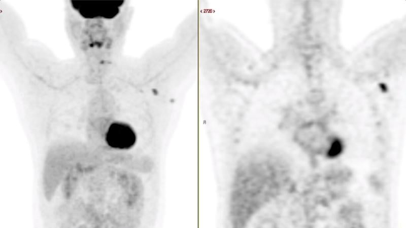 A 63-year-old multiple myeloma patient with skeletal pain showing new FDG PET-CT avid axillary lymphadenopathy 62 days (9 weeks) after second COVID-19 mRNA vaccination dose. The uptake in the lymph node is typical of vaccinated patients, with the adenopathy occuring on the side with the arm that was vaccinated.  Example of axillary adenopathy from the COVID-19 vaccine. Image courtesy of RSNA.