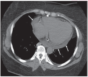 55-Year-Old Man Who Underwent Nephrectomy for Renal Cell Carcinoma: Unenhanced axial chest CT demonstrates mild pericardial effusion (arrows). Patient required postoperative mechanical ventilation.