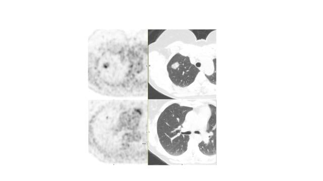 Staging F-18 FDG PET/CT images of adenocarcinoma in the RUL of the lung illustrates the value of Vereos. The primary lesion in the right upper lobe appears in the upper row (PET image is left, CT image is right). A 3 mm synchronous primary or metastatic lesion in the RUL is apparent in the lower row. The precision afforded by Vereos' images provided the basis for the patient to undergo RUL lobectomy instead of thermal ablation of the primary lesion. Images courtesy of Dr. Jay Kikut and UVM