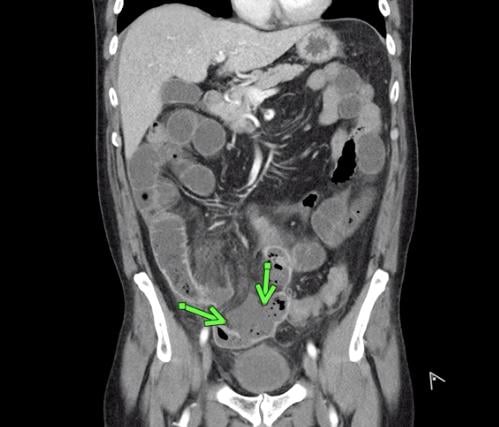 Superior mesenteric artery thrombosis complicated by bowel ischemia and perforation in a 54-year-old man who presented to the emergency department with abdominal pain and was diagnosed with COVID-19. Contrast-enhanced CT images of the abdomen and pelvis show mucosal hyperenhancement involving the small bowel (green arrows). 