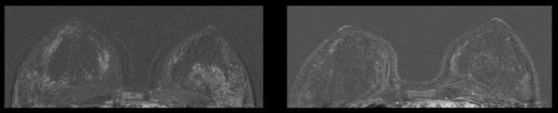 Figure 2. Left image shows 45-year-old patient with IUD in place. Right image shows breast MRI of the same patient 32 months after IUD removal.