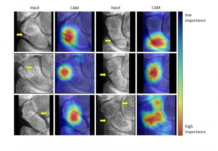 Examples of class activation maps (CAMs) for localizing fractures. The interpretation of the CAMs follows from the color coding of a heat map, in which pixel regions with a warm color signify a greater influence on the final decision of the network than regions with a cold color. The yellow arrows projected on the input images indicate the fracture lines, and they are only shown for reference. Image courtesy of the Radiological Society of North America