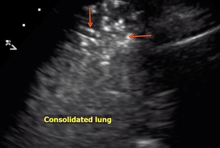 An example of COVID-19 (SARS-CoV-2) pneumonia lung consolidation on ultrasound. See this image moving in the <a href="https://www.itnonline.com/videos/video-covid-pneumonia-lung-consolidation-ultrasound" target="_blank">VIDEO: COVID Pneumonia Lung Consolidation on Ultrasound</a>.