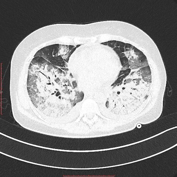 Transverse view of as lung CT showing heavy areas of COVID pneumonia in the lungs. The heart is in the center on the image. Getty Images