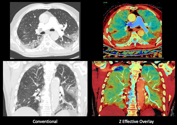 Elderly patient admitted with symptoms consistent with COVID-19. Due to the patient having a dry cough and shortness of breath, a CT was ordered. Images was performed on a Philips IQon spectral CT scanner. The pages show the conventional CT on the left and the Z effective spectral imaging on the same slice, showing areas of COVID pneumonia, including in areas that are not evident on the conventional CT.