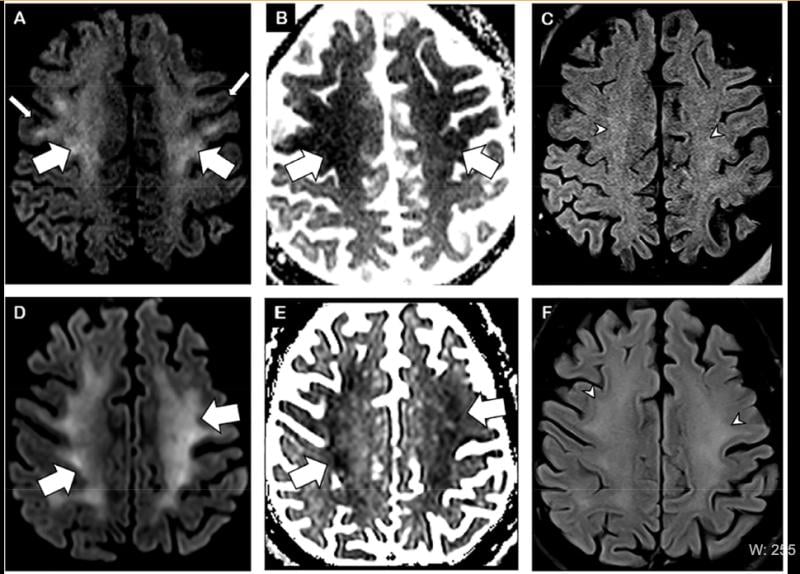 Figure 1 from the Radiology article. Brain MRI in two critically ill COVID-19 patients with persistently depressed mental status including a 56-year old man (A-C), and a 64-year old man (D-F). Axial diffusion-weighted (A, D), apparent diffusion coefficient (B, E) and FLAIR (C, F) images at the level of centrum semiovale in both patients demonstrate symmetric diffuse T2/FLAIR hyperintensity (arrowheads) and mild restricted diffusion (thick arrows) involving the deep and subcortical white matter with relative