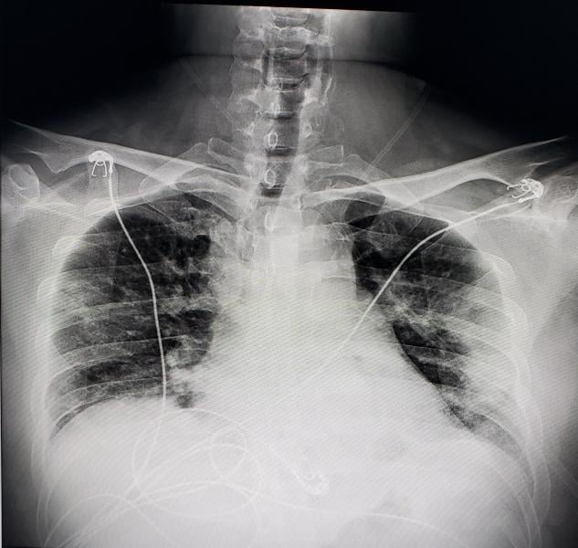Digital radiography (DR) chest X-ray of a COVID-19 patient from Texas, showing COVID pneumonia along the sides of the chest walls. Photo from radiologist John Kim, M.D.