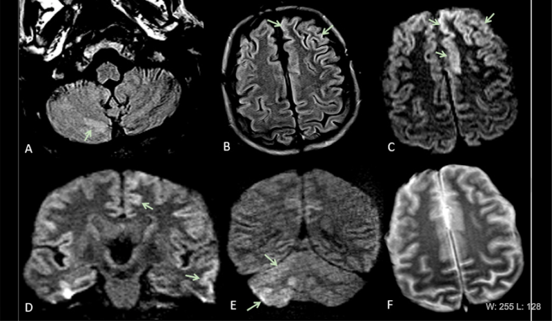 COVID-19 has been found to cause clooting in some patients, causing strokes and pulmonary embiolism. This series of images show brain MRIs in two critically ill COVID-19 patients with persistently depressed mental status including a 56-year old man (A-C), and a 64-year old man (D-F). Axial diffusion-weighted (A, D), apparent diffusion coefficient (B, E), and FLAIR (C, F) images at the level of centrum semiovale in both patients demonstrate symmetric diffuse T2/FLAIR hyperintensity (arrowheads) and mild rest