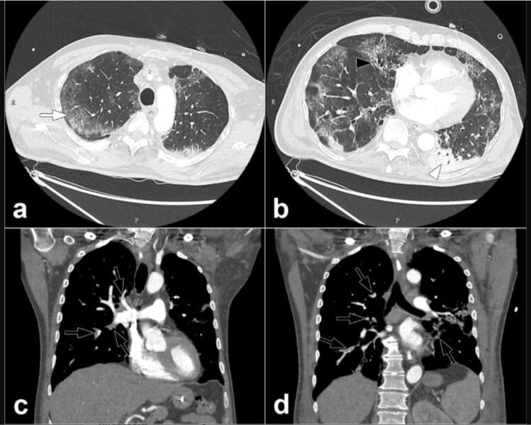 COVID-19 causes blood to clot in some patients, which can lead to pulmonary embolisms, as seen here in this COVID patient, from the journal Radiology. Read more about this COVID complication and find more information on these images.
