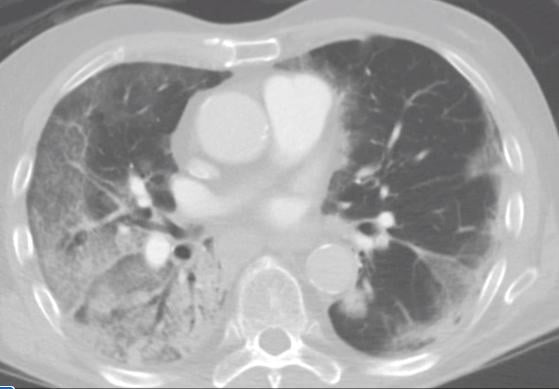 Computed tomography (CT) showing COVID-19 pneumonia in the lungs with ground glass opacifies (GGOs) seen in typical COVID locations, clinging along the lower sections of the lung walls. See the entire CT dataset scroll through video. Image courtesy of Margarita Revzin et al. 
