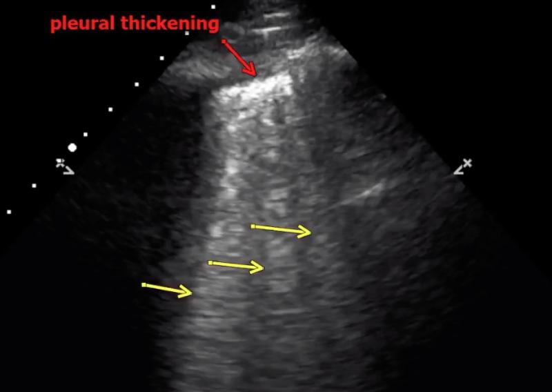 An example of COVID-19 (SARS-CoV-2) pneumonia lung consolidation on ultrasound and related B-lines in the image. See this image in motion in the <a href="https://www.itnonline.com/videos/video-covid-pneumonia-lung-consolidation-ultrasound" target="_blank">VIDEO: COVID Pneumonia Lung Consolidation on Ultrasound.</a>.