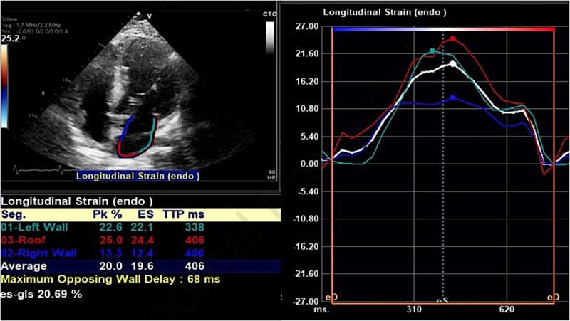 An example of a strain echo from the study showing reduced peak longitudinal/reservoir left atrial strain in a COVID-19 patient who developed atrial fibrillation during admission. A Average left atrial strain here is 20% (normal should be above 38%). Researchers at Johns Hopkins Medicine showed in a May 2021 Journal of the American Society of Echocardiography study that speckle-tracking strain echocardiograms may predict which patients with COVID-19 are most at risk of developing atrial fibrillation (AF).​​