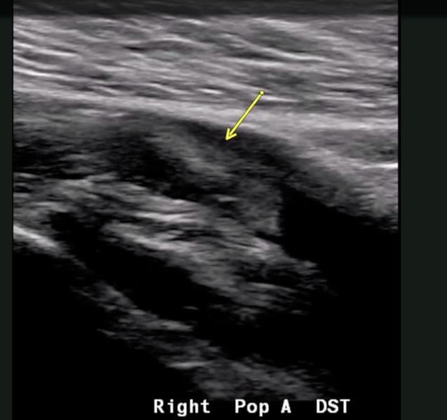 An example of popliteal artery thrombosis formation caused by COVID-19 (SARS-CoV-2). Coronavirus often caused thrombus formation in the body, leading to numerous types of complications, including pulmonary embolism, stroke, heart attack, deep vein thrombosis (DVT) and ischemia or infarcts in various organs.