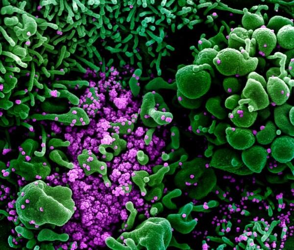 This color-enhanced image, taken by scanning electron microscopy, shows huge quantities of SARS-CoV-2 particles (purple) that have burst out of kidney cells (green), which the virus hijacked for replication. The the bulging, spherical cells in the upper right and bottom left corners are distorted and about to burst from the viral particles inside, and are beginning to self-destruct. Image from NIAID Integrated Research Facility.