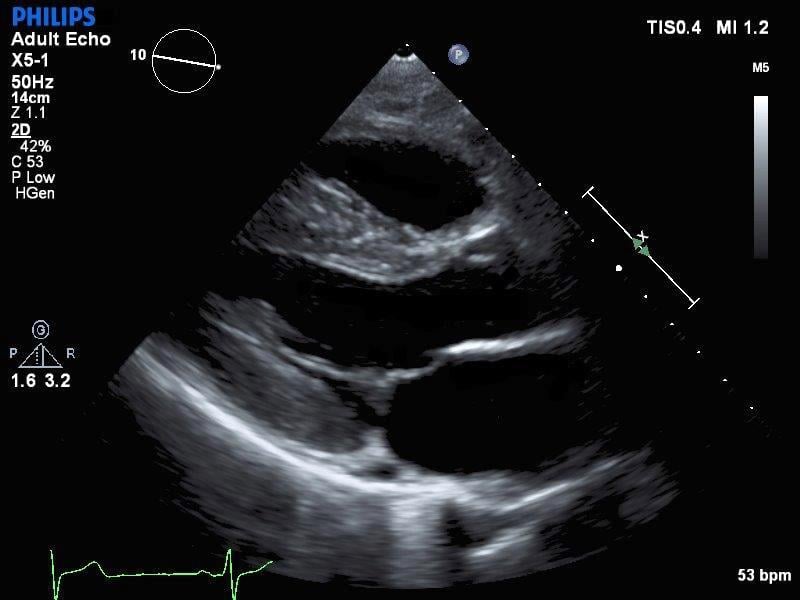 Philips Epiq ultrasound system, heart valve ultrasound, echo, image.