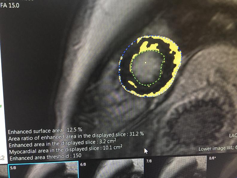 This is a sample of the new cardiac MRI analysis software released by Fujifilm this week at the HIMSS 2019 conference.