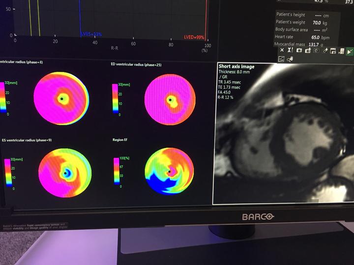 This is a sample of the new cardiac MRI analysis software released by Fujifilm this week at the HIMSS 2019 conference.