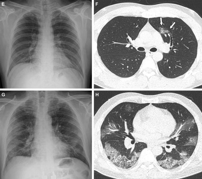 Approximately 59% of fully vaccinated patients had no evidence of COVID-19 pneumonia on CT, compared to 22% of unvaccinated patients