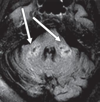 COVID-19-related disseminated leukoencephalopathy (CRDL) represents an important, although uncommon, differential consideration in patients with neurologic manifestations of coronavirus. Axial FLAIR MR image shows T2 prolongation in bilateral middle cerebellar peduncles (arrows). Findings were associated with restricted diffusion and areas of T1 hypointense signal without enhancement or abnormal susceptibility. Image courtesy of American Roentgen Ray Society (ARRS), American Journal of Roentgenology (AJR).