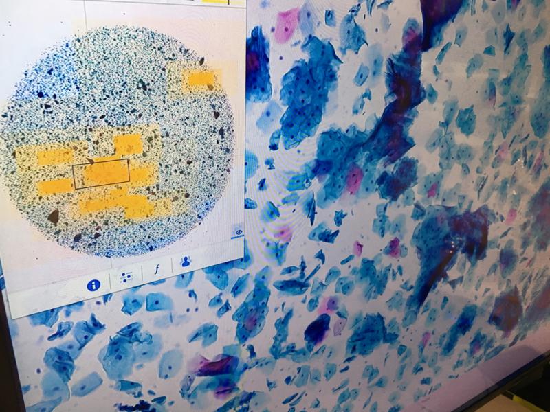 A digital pathology slide called up on a Sectra workstation. As healthcare moves toward a totally digital record environment, pathology departments are being integrated with digital images of their slides, analysis software and reporting that integrates into electronic medical records..