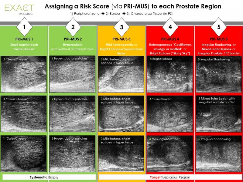 Table showing the PRI-MUS (prostate risk identification using micro-ultrasound) protocol, the first risk identification protocol developed specifically for micro-ultrasound of the prostate.Table showing the PRI-MUS (prostate risk identification using micro-ultrasound) protocol, the first risk identification protocol developed specifically for micro-ultrasound of the prostate.