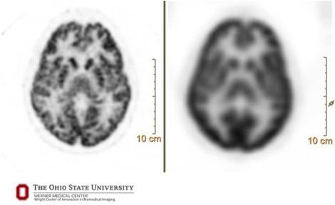 A 90-second brain acquisition with FDG radiotracer — comparison of digital (Vereos, left, 1 mm) and conventional (Gemini TF, 4 mm) images.