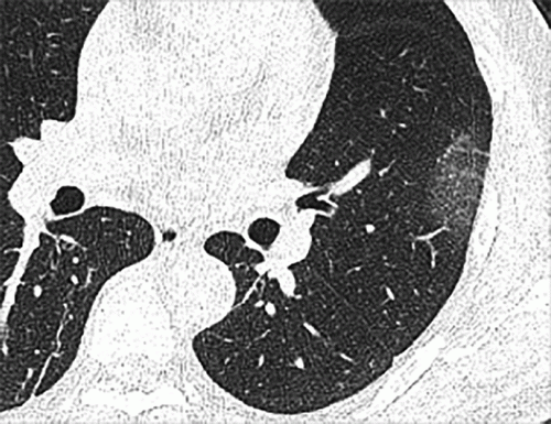 #COVID19 #Coronavirus #2019nCoV #Wuhanvirus #SARScov2 Chest CT findings in adult patients with COVID-19 on transaxial images. (a) Female, 36 years old, 1 day after symptom onset. Subpleural ground-glass opacity in left lower lobe; (b) Male, 54 years old, 4 days after symptom onset. Subpleural ground-glass opacity in left lower lobe with inter- and intralobular septal thickening (crazy paving) and a ground-glass nodule in the right lower lobe (arrow); (c) Male, 28 years old, 3 days after symptom onset. Subpl
