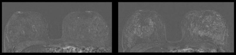 Left image shows breast MRI in 41-year-old patient without IUD. Right image shows increased parenchymal enhancement in the same patient 27 months after IUD placement. Image courtesy of RSNA