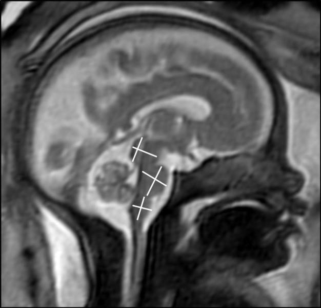 This images shows an MRI of fetal brain development. Image courtesy of RSNA