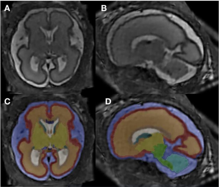 MRI super-resolution reconstruction and atlas-based tissue segmentation. Image courtesy of RSNA