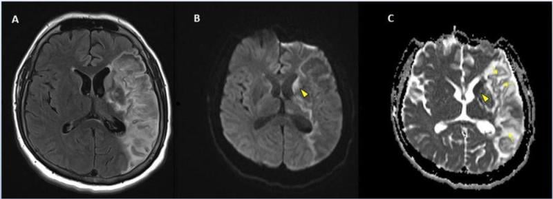 Stroke seen in a 41-year-old male patient with COVID-19 infection. Image courtesy of RSNA
