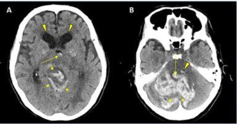 CT showing hemorrhage in a 68-year-old male patient with COVID-19 infection. Image courtesy of RSNA